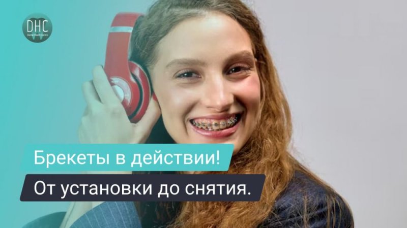 Как работают брекеты: от установки до снятия.