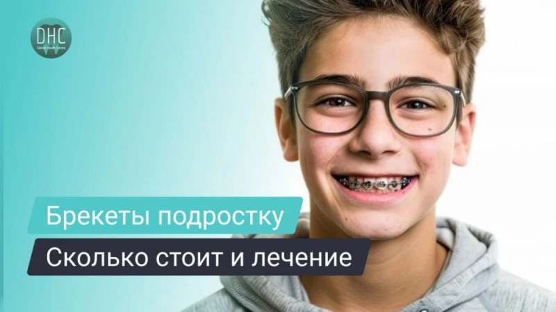 Сколько стоят брекеты для подростков: что влияет на цену лечения