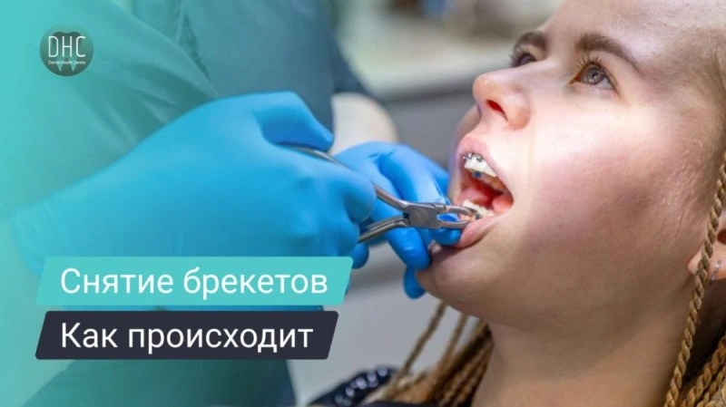 Как происходит снятие брекетов у ортодонта