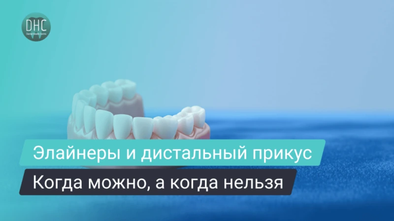 Элайнеры при дистальном прикусе — полный разбор: кому подойдут и сколько носить